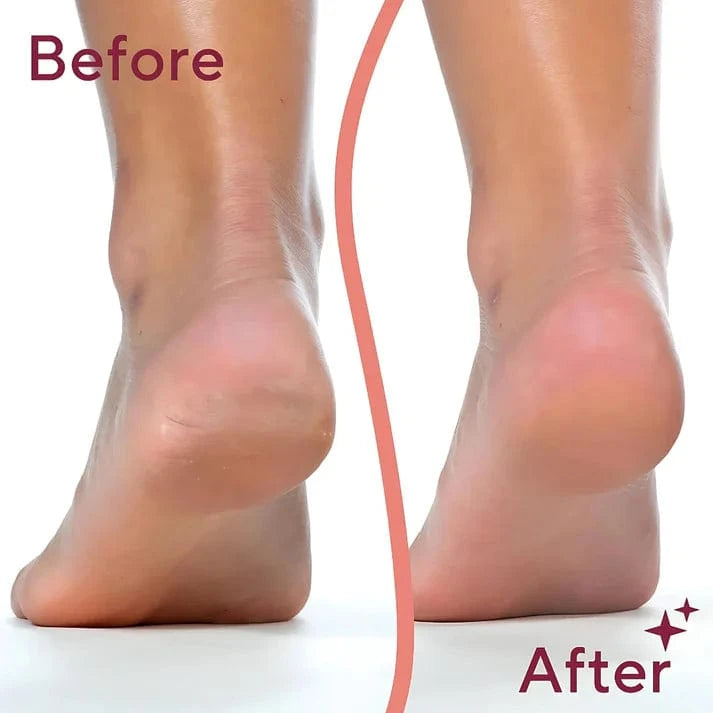 🦶 Callus Remover by QuickTech